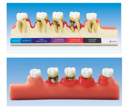 齒槽膿漏(牙周病)展示模型