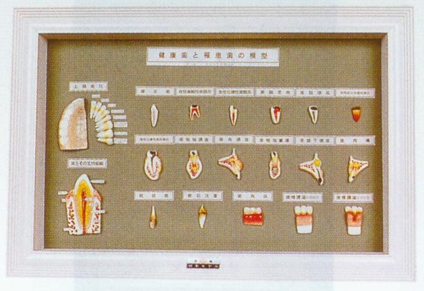 健康牙齒與蛀牙模型