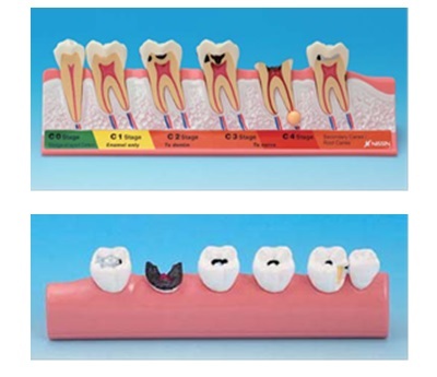 蛀牙階段模型